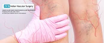 Vascular Surgery in the Intensive Care Unit